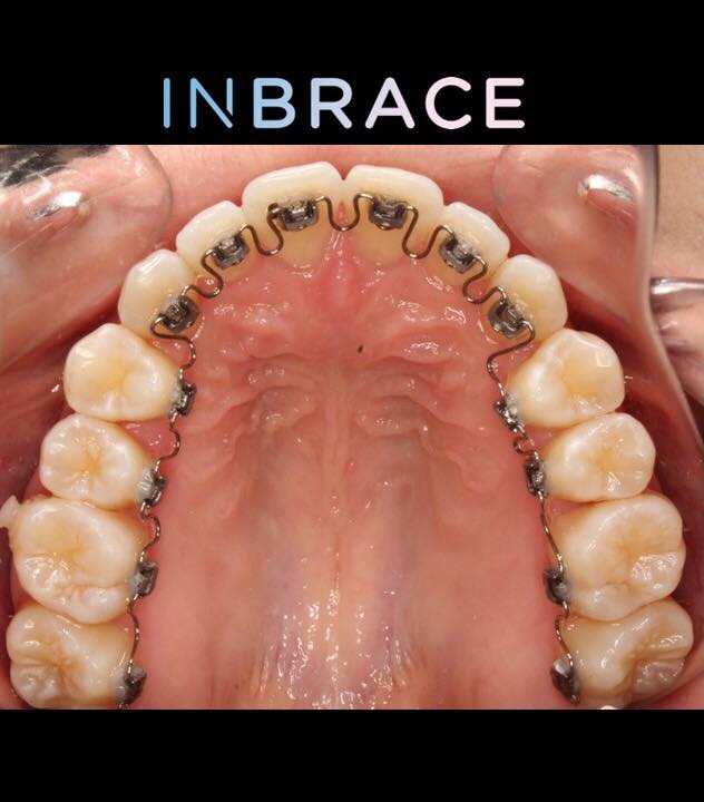 lingual braces barca fontanacountryinn com lingual braces
