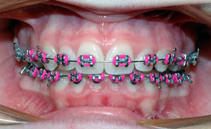 Metal Braces  Riviera Orthodontics