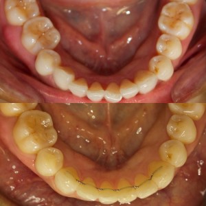 Crowding and severely rotated molar